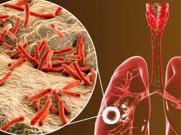 Tuberculosis, Maldonado, investigacion